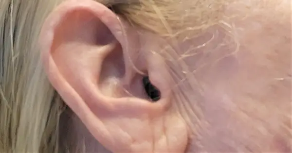 Hearing-loss.news - Mixed Hearing Loss
